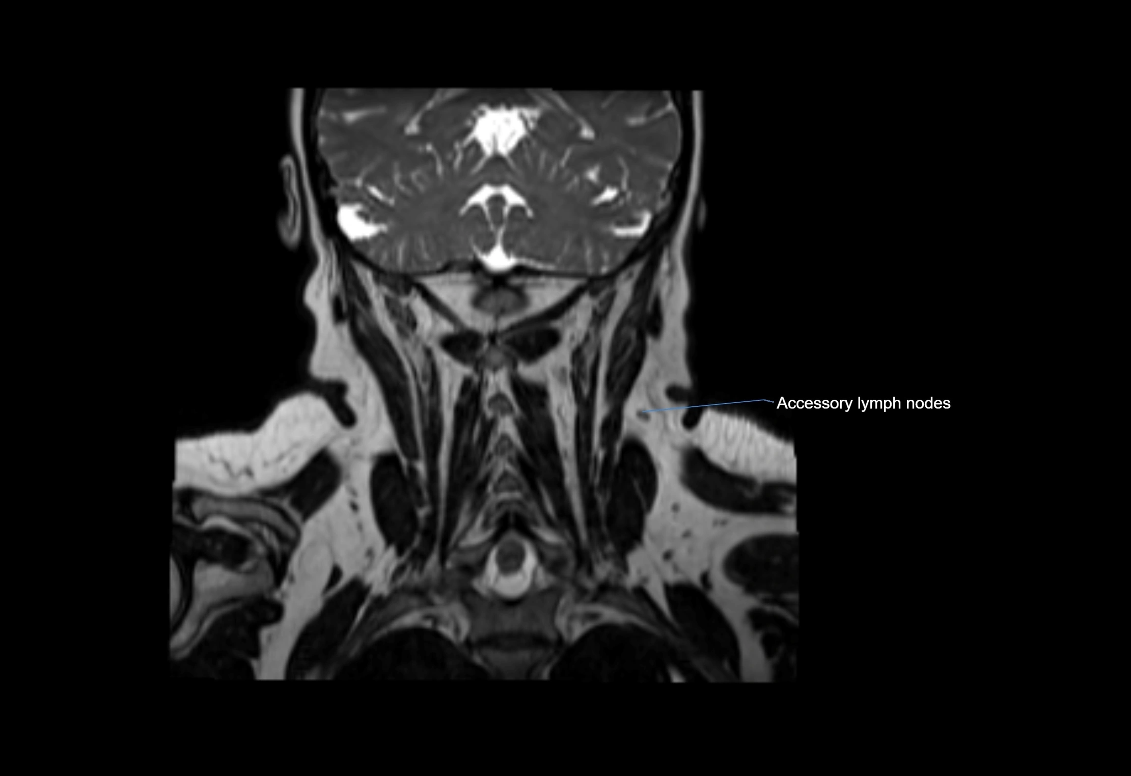 Neck coronal lymph node cross sectional MRI anatomy 3T MRI  image-img-00001-00017.webp
